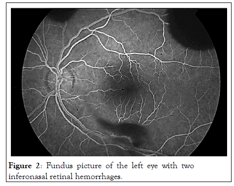 JCEO-retinal