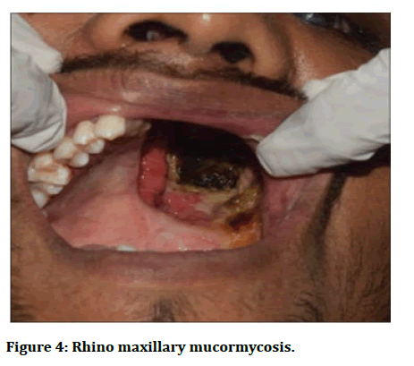 JRMDS-maxillary