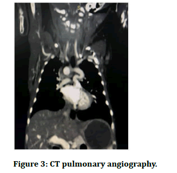 JRMDS-pulmonary