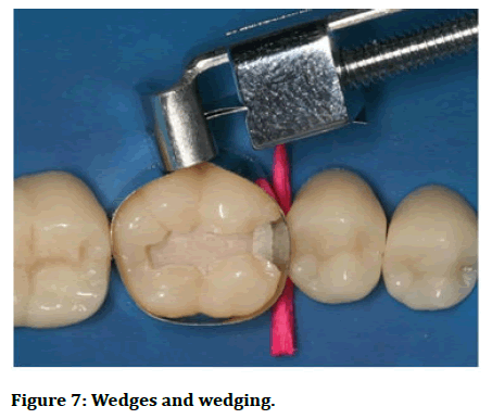 JRMDS-wedging