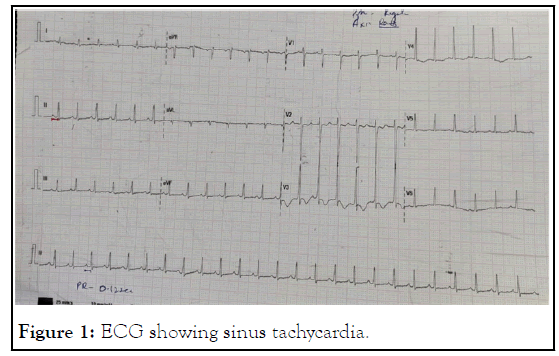 tachycardia