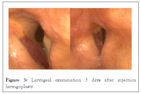 Laryngeal