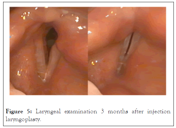 laryngoplasty