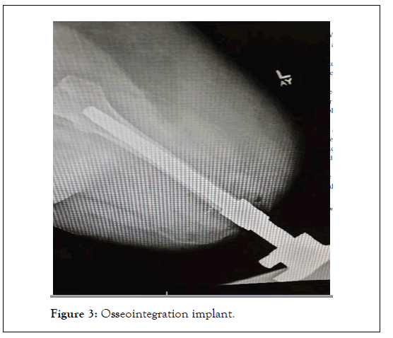 Physical-Medicine-implant