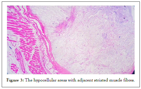 hypocellular