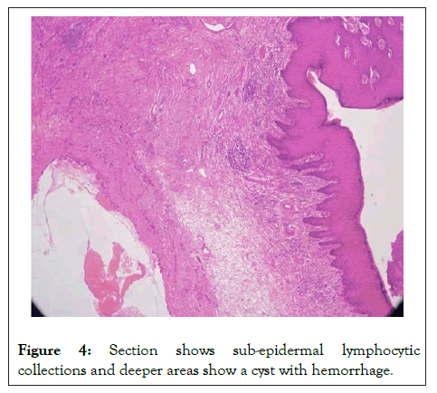 lymphocytic