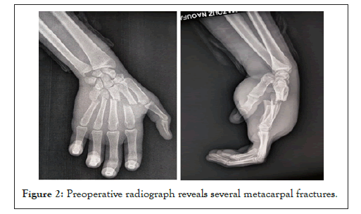 metacarpal