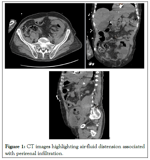 perirenal