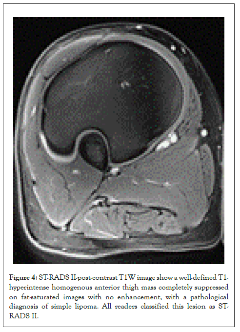 lipoma