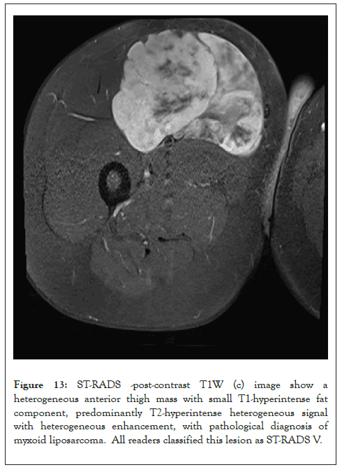 liposarcoma