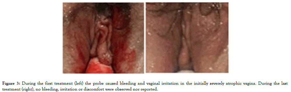 Women-Health-bleeding