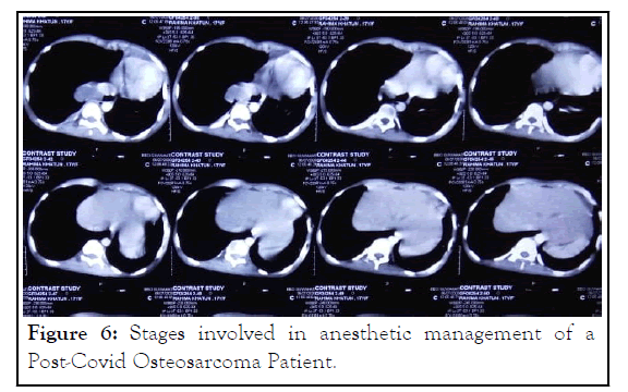 anesthesia-Osteosarcoma