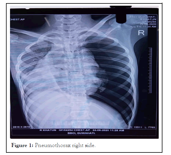 anesthesia-Pneumothorax