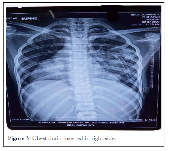 anesthesia-inserted