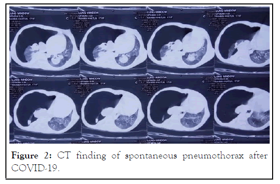 anesthesia-spontaneous