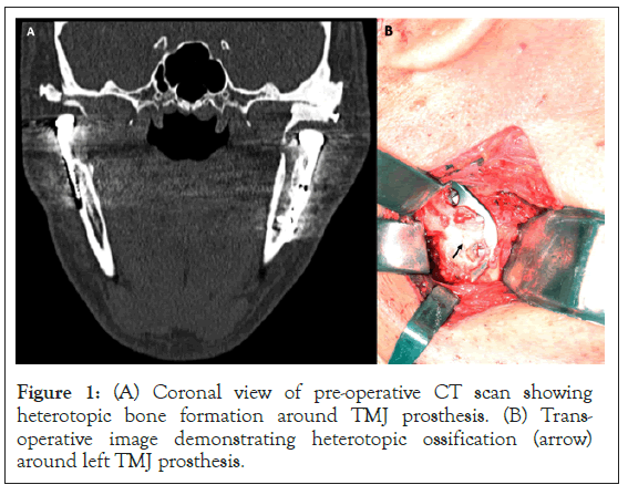 Coronal