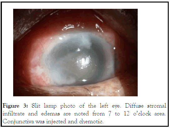 Conjunctiva