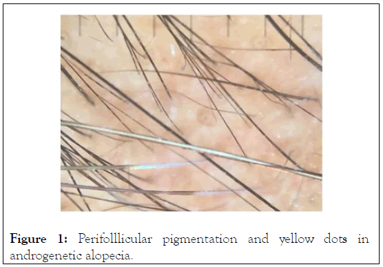 Perifolllicular