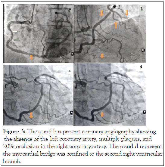 clinical-trials-coronary