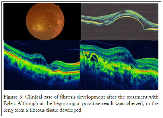 fibrosis