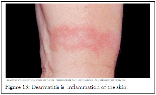 Dearmatitis