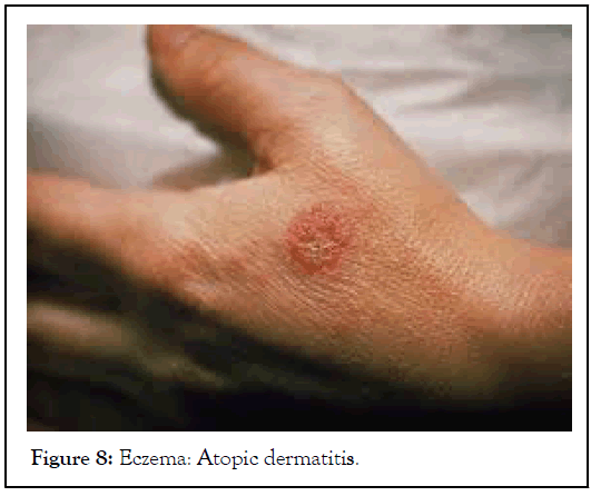 Eczema