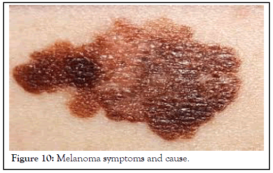 Melanoma