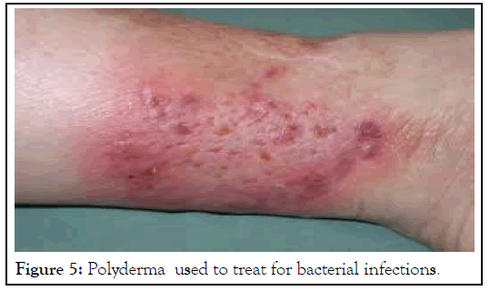 Polyderma