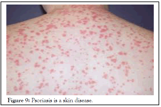 Psoriasis