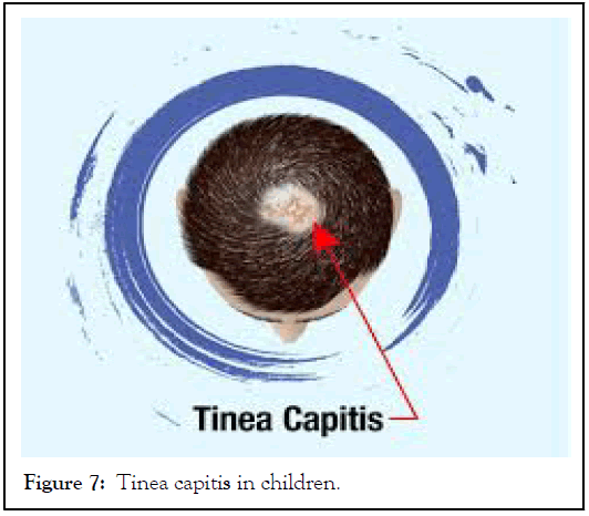 Tinea