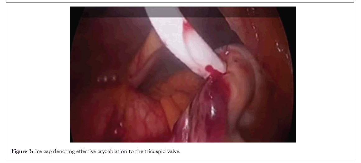 experimental-cardiology-cryoablation