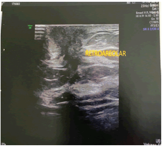 gynecology-obstetrics-Retroareolar