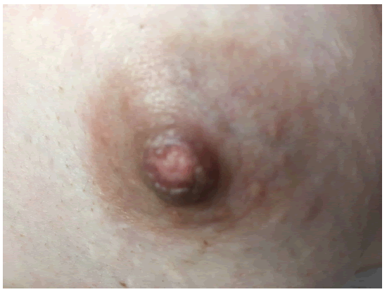 gynecology-obstetrics-nipple