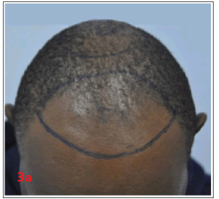 hair-transplantation-hair-therapy-africa