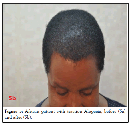 hair-transplantation-hair-therapy-after