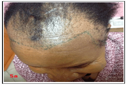 hair-transplantation-hair-therapy-alopecia