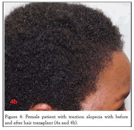 hair-transplantation-hair-therapy-hair