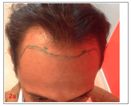 hair-transplantation-hair-therapy-male