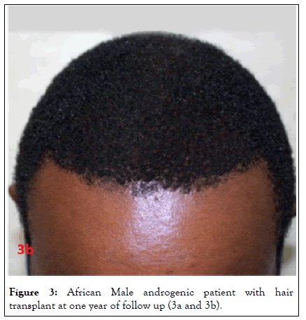 hair-transplantation-hair-therapy-one