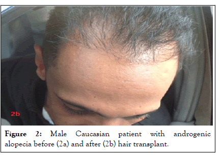hair-transplantation-hair-therapy-patient