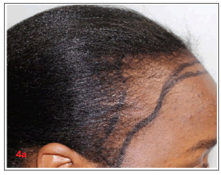 hair-transplantation-hair-therapy-traction