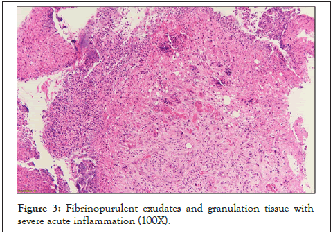 hepatology-exudates