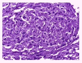 journal-research-eosinophilic