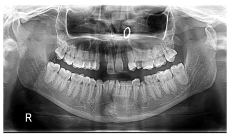 journal-research-fracture