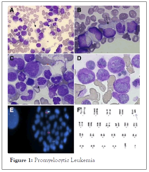 leukemia-Promyelocytic