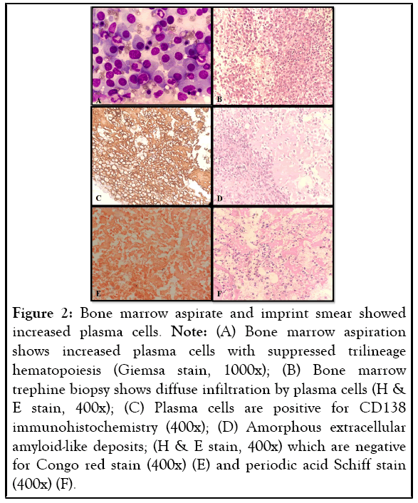 leukemia-aspiration