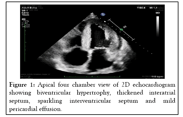 leukemia-echocardiogram