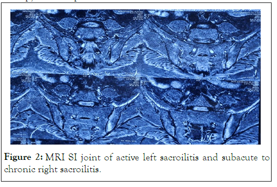 lupus-joint