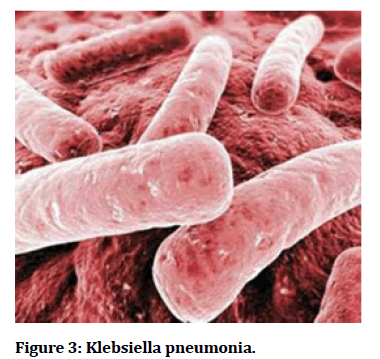 medical-dental-Klebsiella-pneumonia