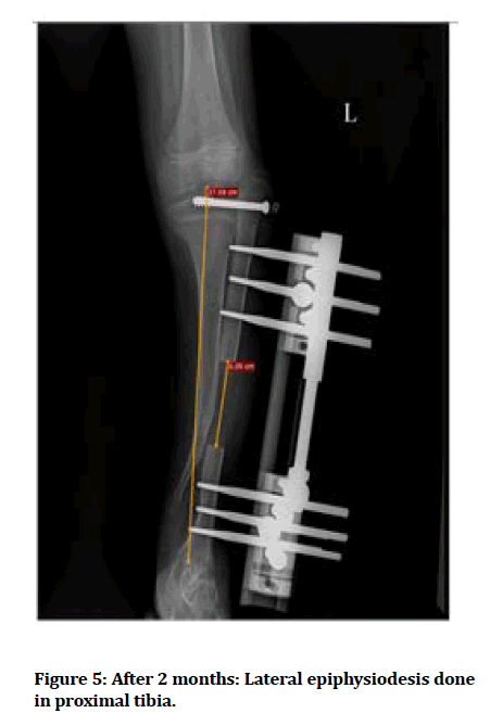 medical-dental-epiphysiodesis